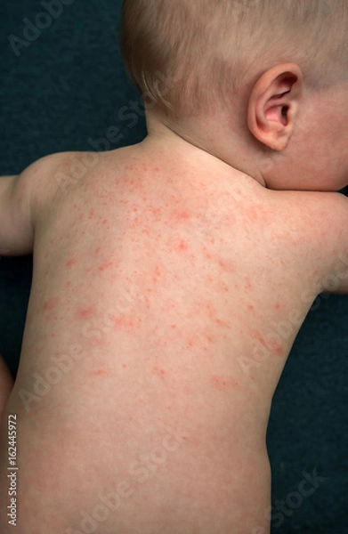 Fototapeta Allergies, pimples on the baby's skin. Food allergy.