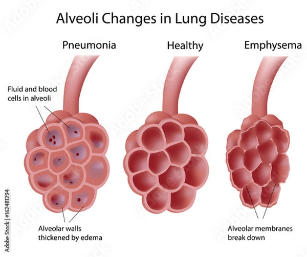 Obraz Alveolus changes in lung diseases