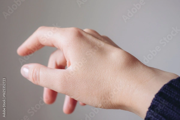 Fototapeta Female right back hand with ganglion cyst on the dorsum,  fluid-filled bump associated with a joint or tendon sheath, close-up view, selected focus.