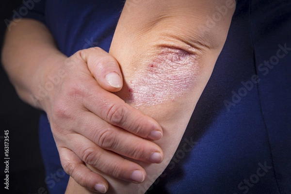Obraz Psoriasis on elbow