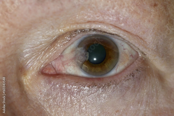 Obraz Flügelfellerkrankung an einem Auge