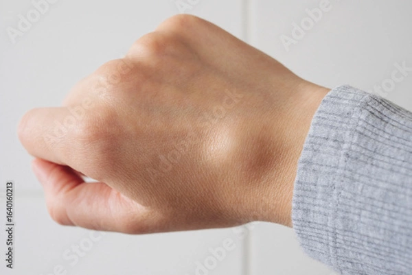Fototapeta Female right back hand with ganglion cyst on the dorsum,  fluid-filled bump associated with a joint or tendon sheath, close-up view, selected focus.