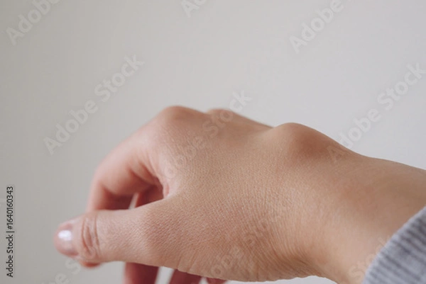 Fototapeta Female right back hand with ganglion cyst on the dorsum,  fluid-filled bump associated with a joint or tendon sheath, close-up view, selected focus.