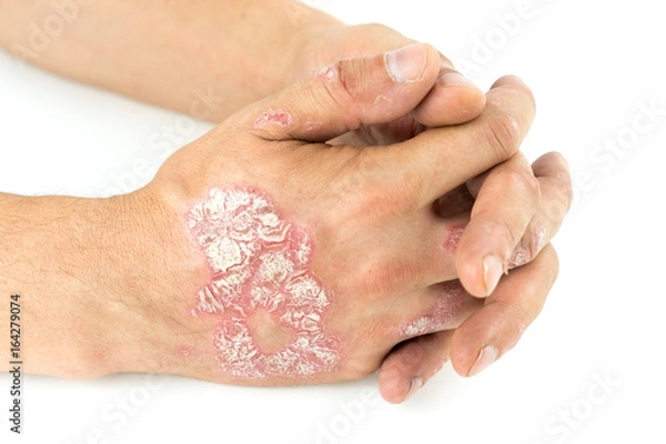 Fototapeta Psoriasis vulgaris on the male hands with plaque, rash and patches, isolated on white background. Autoimmune  genetic disease.