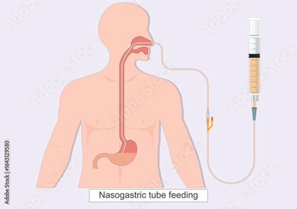Obraz Nasogastric tube feeding (NG) is a thin flexible tube