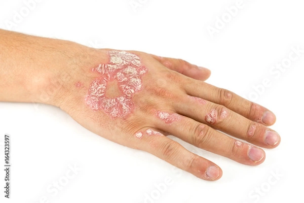Fototapeta Psoriasis vulgaris on the male hand and finger nails with plaque, rash and patches, isolated on white background. Autoimmune genetic disease.