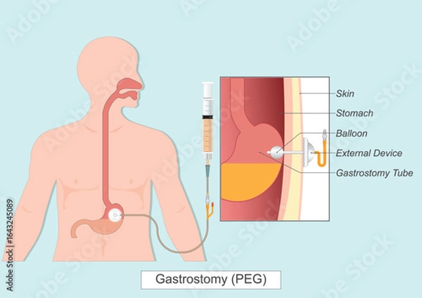 Obraz Gastrostomy or PEG Tube.