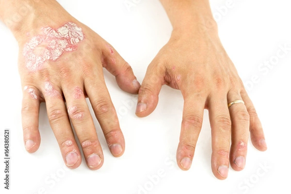 Fototapeta Psoriasis vulgaris on the mans hands with plaque, rash and patches, isolated on white background. Autoimmune  genetic disease.