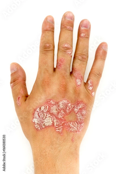 Fototapeta Psoriasis vulgaris on the man hand and finger nails with plaque, rash and patches, isolated on white background. Autoimmune genetic disease.