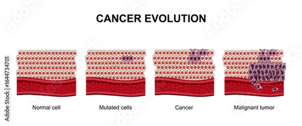 Fototapeta cancer evolution from mutated normal cells to malignant tumors, hyperplasia and dysplasia. The spread of cancer cells. Medical vector illustration, poster or science study.