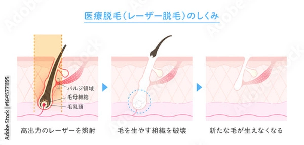 Fototapeta 脱毛のイメージ、医療脱毛・レーザー脱毛のしくみ