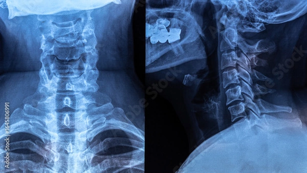 Fototapeta X-ray with cervical lordosis. P-signs of osteochondrosis of the cervical spine Def. spondylosis, spondyloarthrosis. Examination of the cervical spine diseases.