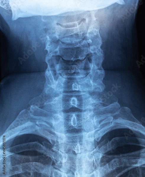 Fototapeta Vertical X-ray with cervical lordosis. P-signs of osteochondrosis of the cervical spine. Spondylosis, spondyloarthrosis. Examination of the cervical spine diseases.