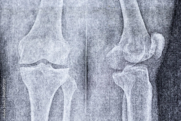 Fototapeta X-ray of knee joint with osteoarthritis. Subchondral sclerosis of the articular surfaces, marginal bone growths, moderate narrowing of the joint space.