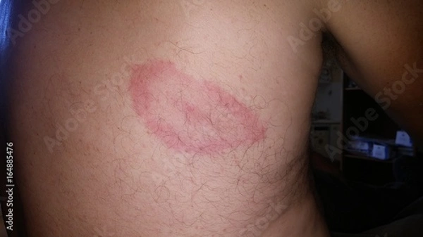 Obraz Erythème migrant