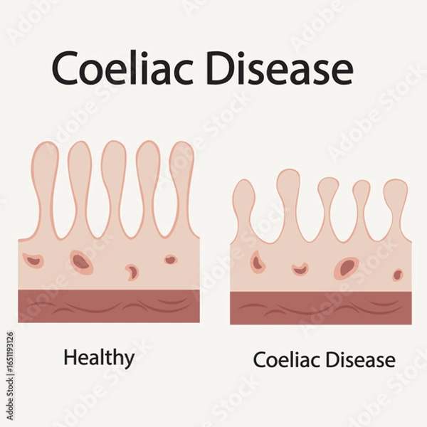 Obraz Flat vector illustration of coeliac disease showing key symptoms like bloating, diarrhea, fatigue, and highlighting related conditions such as IBS and Crohn’s disease.