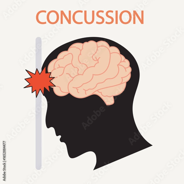 Obraz Flat vector illustration of concussion showing headache, dizziness, nausea, memory issues, with related disorders like migraine, whiplash, and post-traumatic head injuries. silhouette