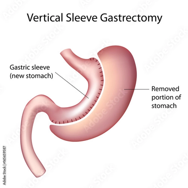 Obraz Vertical Sleeve Gastrectomy (VSG), labeled. 
