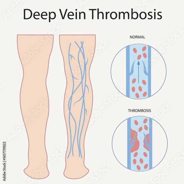 Obraz Deep vein thrombosis vector: shows leg swelling, pain, warmth, redness, vein tenderness; highlights risk of pulmonary embolism and similarities to varicose veins and cellulitis.