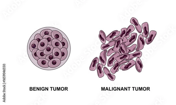 Fototapeta Vector illustrations of malignant and benign tumors in body tissues. Spread of cancer cells. Medical vector illustrations for education, posters, clinics, and science.