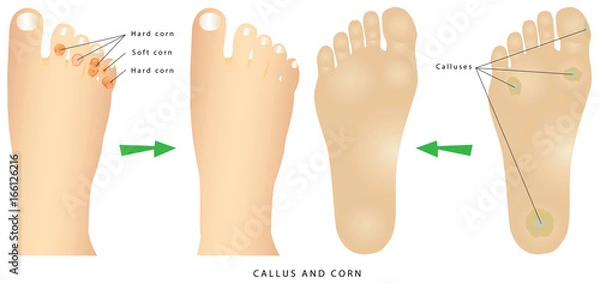 Fototapeta Odciski i modzele