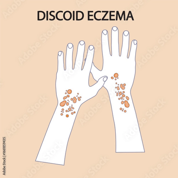 Obraz Vector illustration of discoid eczema showing round, itchy, scaly patches. Highlights symptoms and helps distinguish from similar conditions like ringworm and psoriasis icon