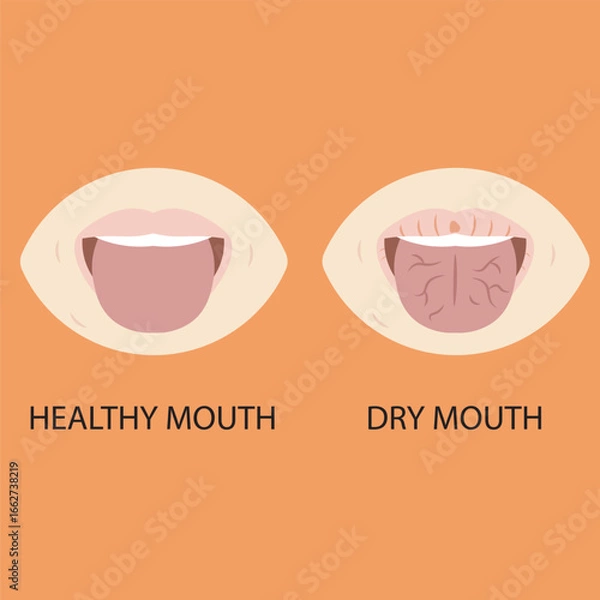 Obraz Vector illustration of dry mouth, showing thirst, sticky saliva, bad breath, cracked lips, and sore throat; highlights similar conditions like dehydration, Sjögren’s syndrome, diabetes.icon