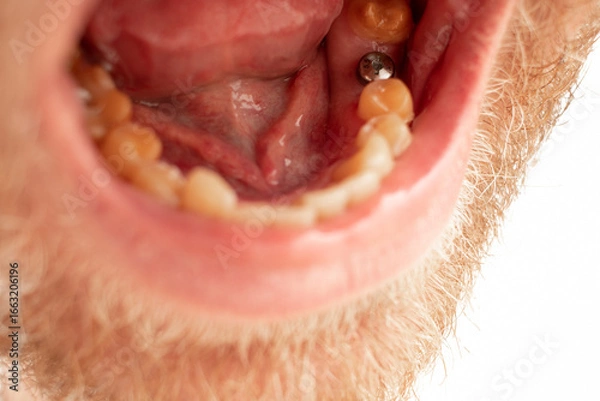 Fototapeta Installing dental implants. Open mouth.