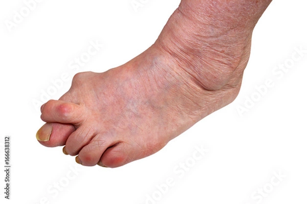 Obraz Medetcin, valgus bunion, leg with deformity valgus hallux (Bunion), the consequence of refusal of treatment, space for text