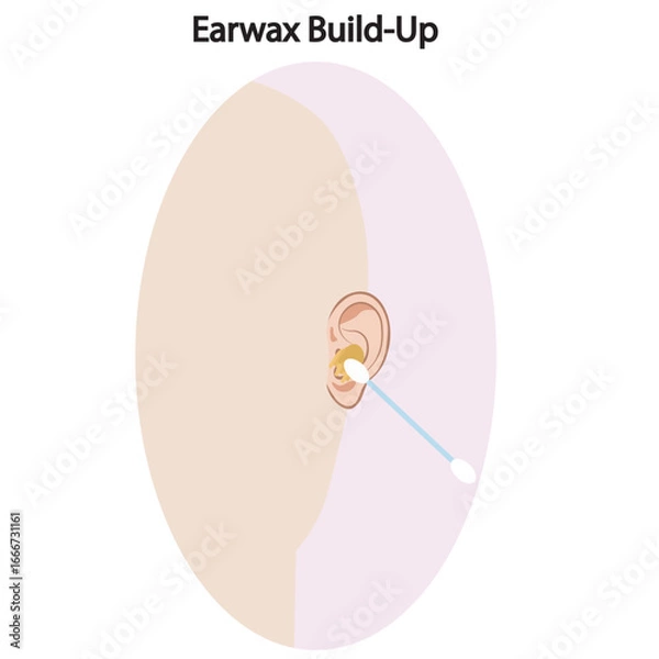 Obraz Vector showing earwax build-up with symptoms like blockage, reduced hearing, itching, discomfort; includes similar conditions such as otitis externa and foreign body obstruction. silhouette