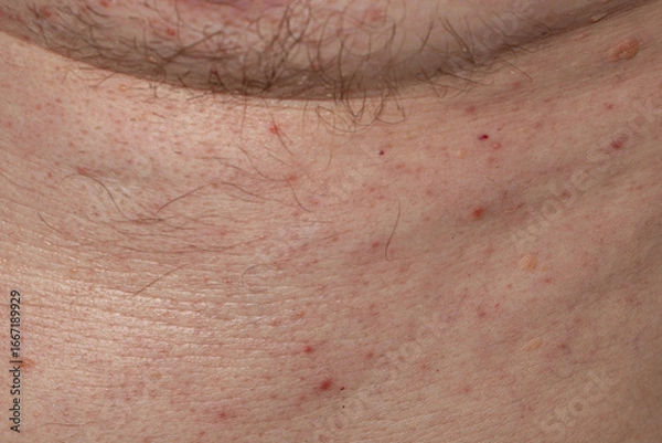 Fototapeta Macro image of irritated male skin on the neck, showing hair follicles, blemishes, and dermatological imperfections. Ideal for use in skincare, dermatology, educational, or health-related visuals