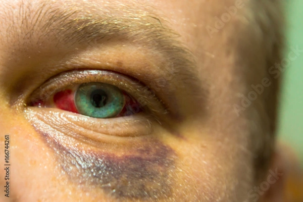 Obraz The usual injury after sparring. Traumapony sport which gives vigor to life.