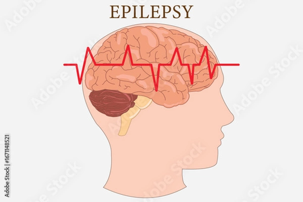 Obraz Medical diagram of epilepsy showing brain activity with electrocardiogram red waveform.