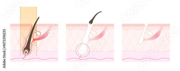 Fototapeta 医療脱毛・レーザー脱毛のしくみ