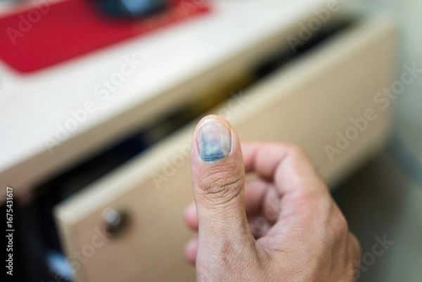 Fototapeta Human thumb finger is hurt by drawer pinched, cause blood blister inthe nail. Unsafe or hazard at workplace, close-up with selective focus.