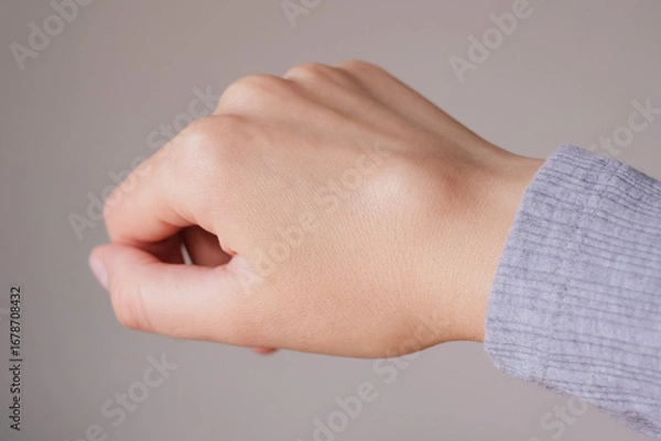 Fototapeta Female right back hand with ganglion cyst on the dorsum,  fluid-filled bump associated with a joint or tendon sheath, close-up view, selected focus.