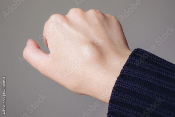 Fototapeta Female right back hand with ganglion cyst on the dorsum,  fluid-filled bump associated with a joint or tendon sheath, close-up view, selected focus.