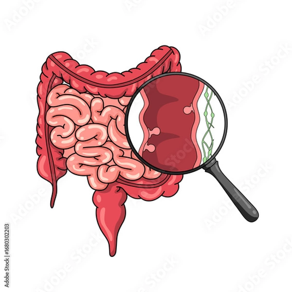 Fototapeta Illustration of colon polyps, inflammation, and hamartomatosis. Pain and inflammation in the human body. Illustration of internal organ examination. Vector for medical and educational purposes.