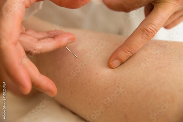 Obraz Accupuncture needle being inserted into skin