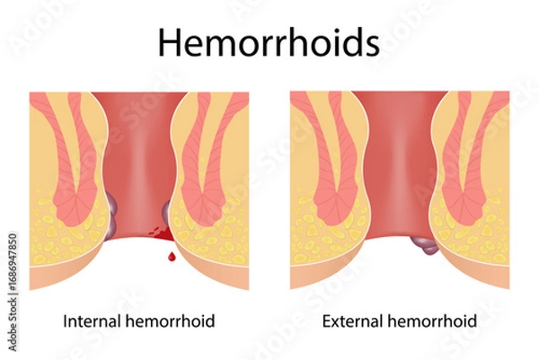 Fototapeta Two types of hemorrhoids. Internal and external. Medical illustration, treatment