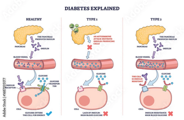 Fototapeta Diabetes types explained with an outline diagram showing pancreas, blood vessel, and cell to illustrate insulin function and glucose uptake. Outline diagram