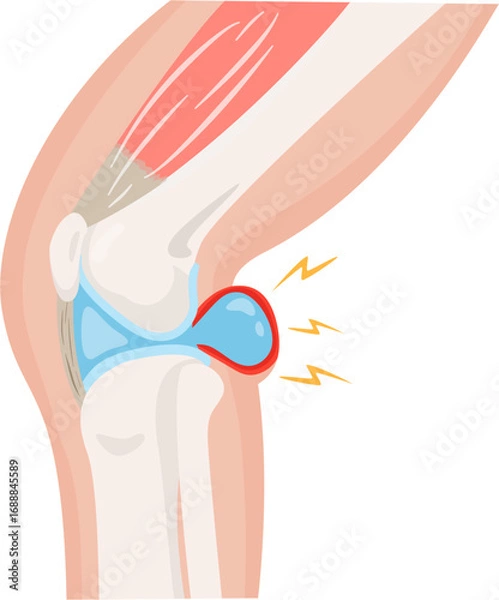 Obraz Baker’s Cyst 