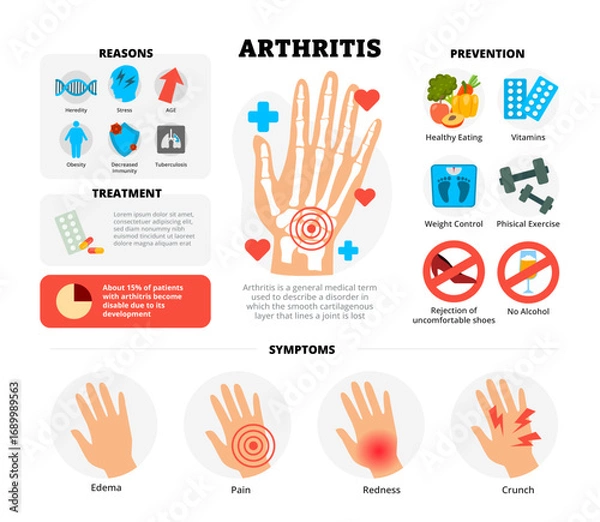 Fototapeta Arthritis infographic design with hand bone skeleton. Vector poster template showing causes, symptoms, treatment, and prevention for medical education, healthcare awareness, chart illustration banner.