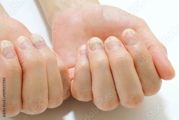 Fototapeta 爪トラブル（爪甲剥離症と緑色爪症）
