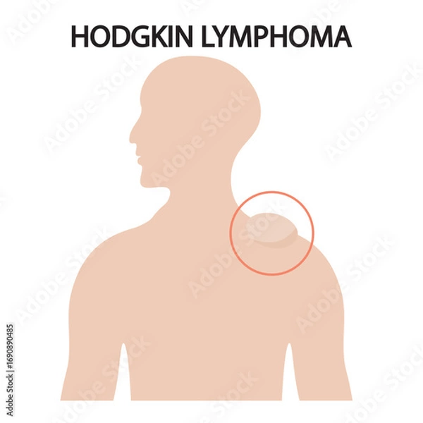 Fototapeta Flat vector illustration of Hodgkin lymphoma highlighting symptoms like swollen lymph nodes, fatigue, fever, night sweats, and similar diseases such as non-Hodgkin lymphoma.