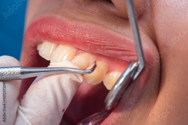 Fototapeta A detailed close up shot showing a dentist meticulously scraping plaque and tartar off the tooth surface while working in a modern dental clinic setting.