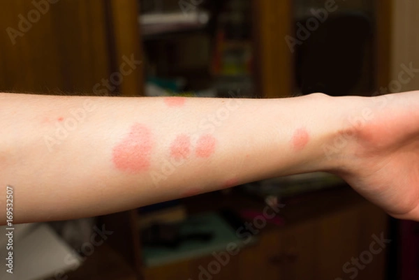 Fototapeta Hand with bites from fleas