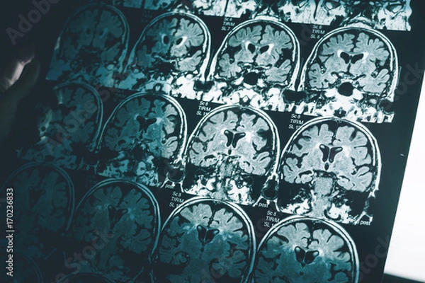 Obraz Alzheimer's disease on MRI film 