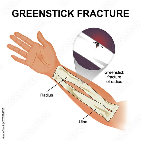 Fototapeta Greenstick Fracture Bone Flashcard Illustration