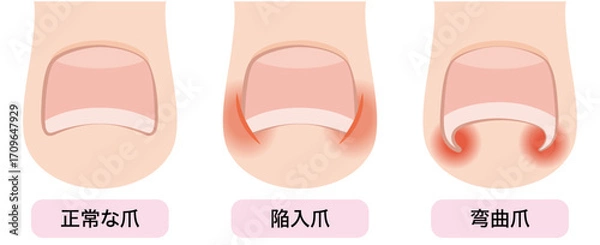 Obraz 巻き爪・陥入爪・弯曲爪